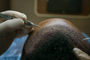 hair transplantation in iran