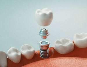 İranda diş implantları