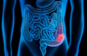 A variety of treatment methods for colon cancer